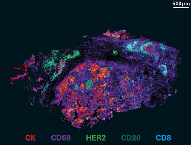 Fluoreszenzmikroskopie-Aufnahme einer Gewebeprobe mit einem Maßstab von 500 Mikrometern und einer farbcodierten Legende für die Marker CK, CD68, HER2, CD20 und CD8.