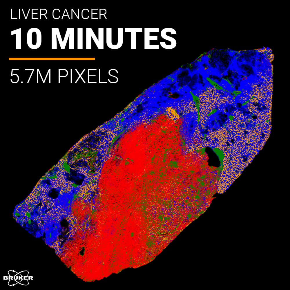 Mikroskopische Aufnahmen von Leberkrebs, die in zehn Minuten 5,7 Millionen Pixel an Daten liefern und in einer Falschfarbendarstellung in Rot, Blau, Grün und Orange dargestellt werden.